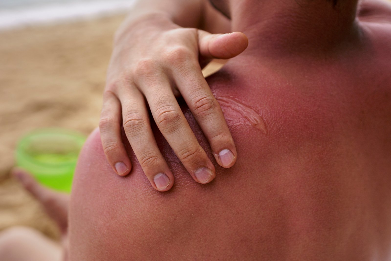 BURN SCAR TREATMENT & RECONSTRUCTION