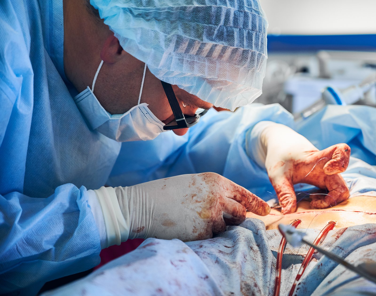 VARICOSE VEINS TREATMENT