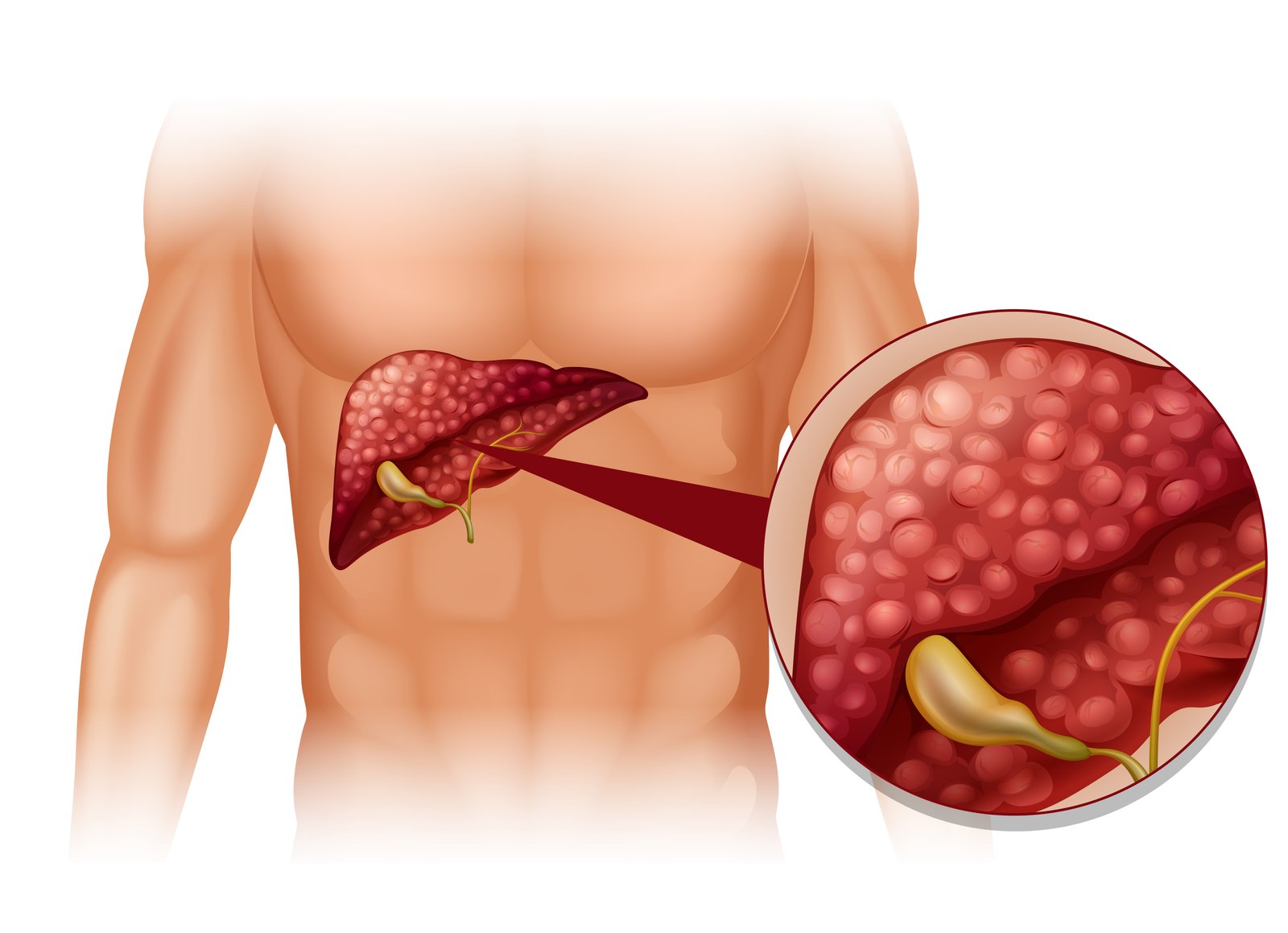 GALL BLADDER SURGERY