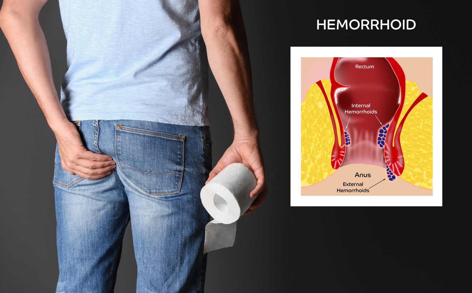 HEMORRHOIDS